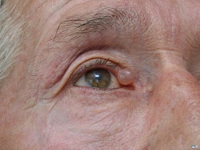Опухоль на веке глаза - основные виды, клинические проявления, методы диагностики, лечение