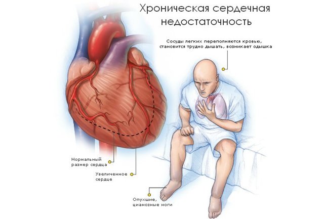 Таблетки от сердечной одышки: тонкости диагностики и лечения