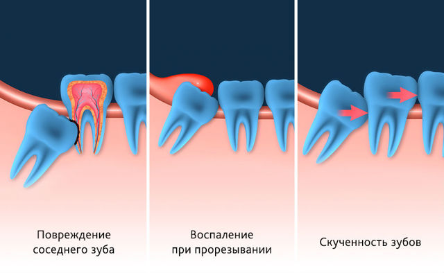 Больно ли вырывать зуб мудрости: симптомы роста, возможные патологии, методы лечения и реабилитации