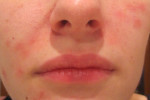 Почему на лице появляются красные пятна: симптомы, домашнее, консервативное и косметическое лечение