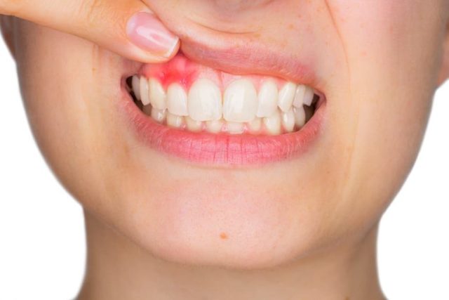 Лечение воспаления корня зуба консервативными способами и средствами народной медицины