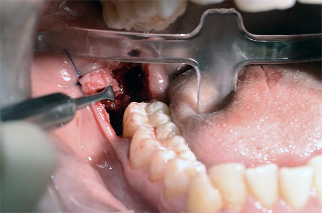 Симптомы зуба мудрости, процедура удаления и восстановления десны
