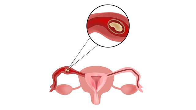 Как происходит внематочная беременность - этиология и симптоматика клинической картины