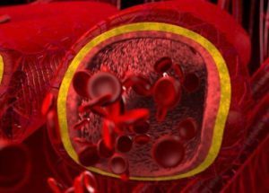 Почему повышаются лейкоциты в крови: причины и признаки лейкоцитоза, способы нормализации состава крови