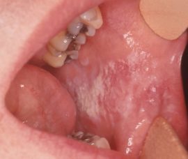Болячки во рту: лечение и профилактика заболеваний