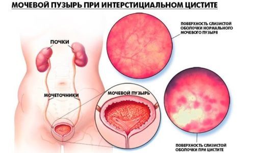 Схема лечения цистита у женщины: диагностика и терапия