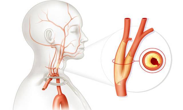 Нестенозирующий атеросклероз артерий у нижних конечностей