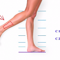 Лечение сосудистых звездочек на ногах - основные причины, способы диагностики, методы терапии