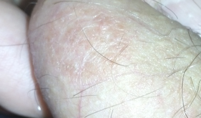 Шелушится кожа на яичках: заболевания, диагностика и лечение