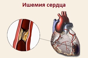 Полувертикальная электрическая позиция сердца: характер явления, возможные причины, необходимые меры