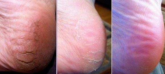 Почему появляются трещины на пятках - причины сухости и ороговения кожи, диагностика и способы лечения