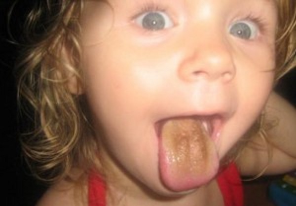 У ребенка коричневый налет на языке: выясним причины, лечение и меры профилактики