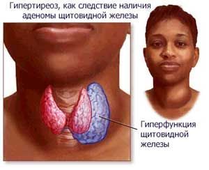 Гипертиреоз субклинический (тиреотоксикоз): клиника, симптомы и лечение