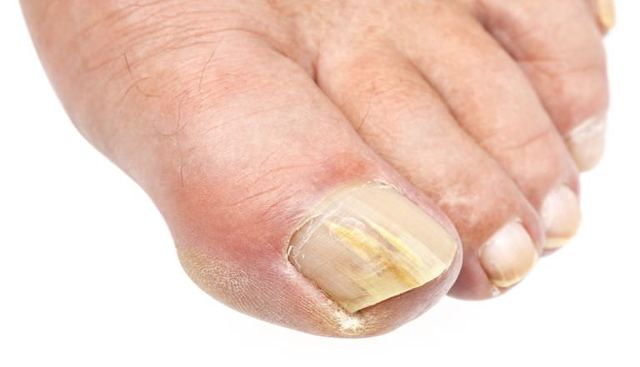 Почему образуется ногтевой грибок на ногах: лечение, признаки, симптомы болезни и профилактика
