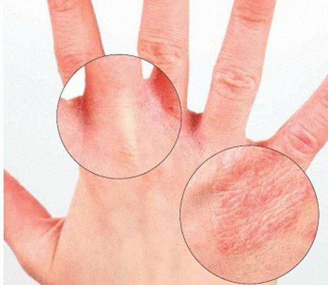 Почему трескается кожа на пальцах: правильный уход за кожей