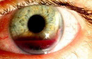 Лечение кровоизлияния в глаз - причины патологии, возможные заболевания, терапевтические мероприятия