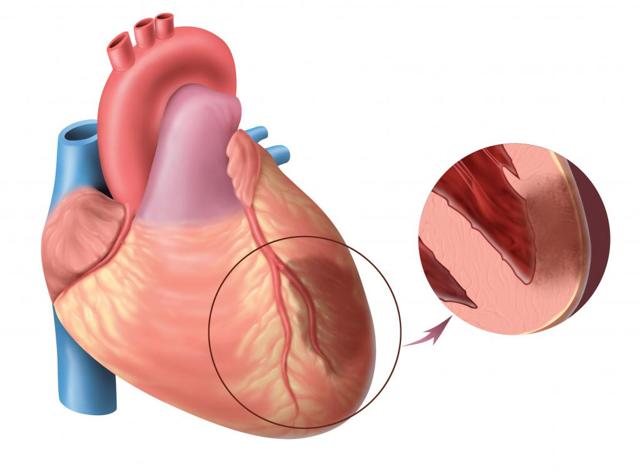 Последствия инфаркта легкого с диагностикой причин его развития, а также лечение основных проявлений заболевания