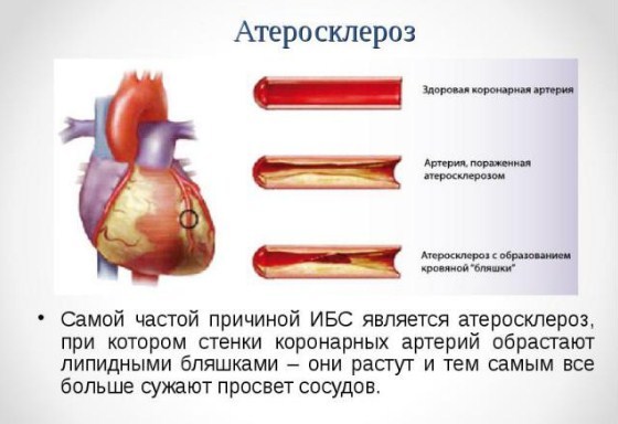 Что представляет собой атеросклероз аорты коронарных артерий