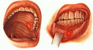 Болячки во рту: лечение и профилактика заболеваний