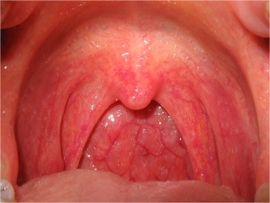 Ожог слизистой рта: симптомы и первая помощь