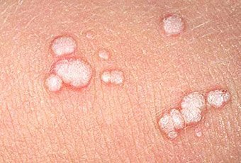 Лечение папиллом на коже: самые распространенные способы