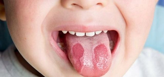 У ребенка коричневый налет на языке: выясним причины, лечение и меры профилактики