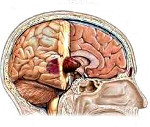 Каковы первые признаки опухоли головного мозга, причины возникновения, необходимое лечение