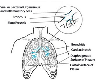 Аллергический бронхит: симптомы заболевания, причины и эффективные методы лечения