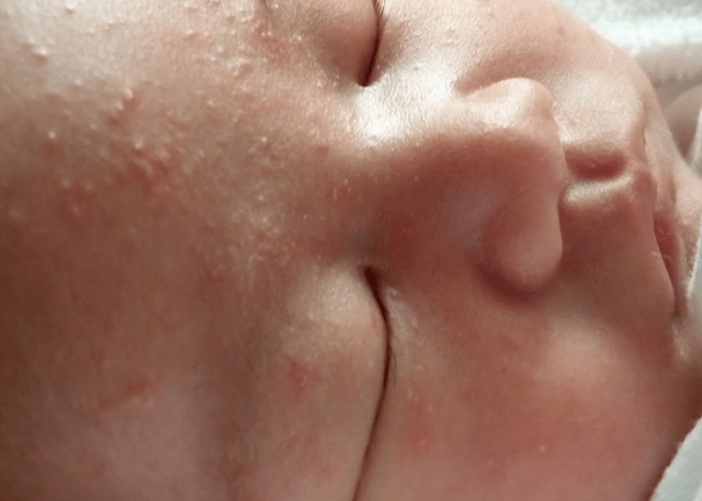 Сыпь у грудничка на лице: причины, диагностика, лечение