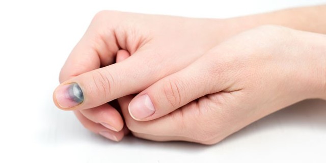 Почему синеют ногти на руках: распространенные причины и методы лечения неприятного симптома