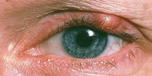 Как лечить ячмень под глазом: медикаментозные, народные методы лечения, симптомы и причины развития