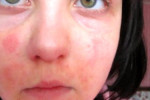 Почему на лице появляются красные пятна: симптомы, домашнее, консервативное и косметическое лечение