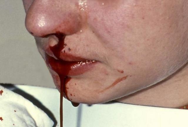 Частые носовые кровотечения у детей: причины, симптомы, первая помощь, методы лечения, профилактика