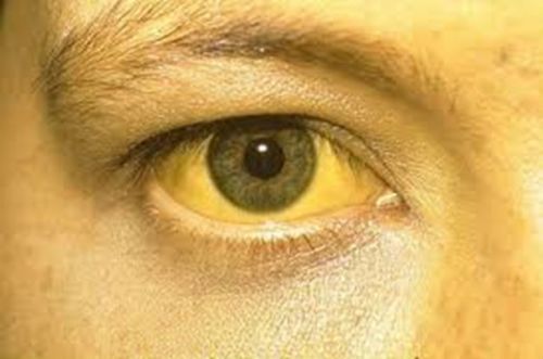 Каротиновая желтуха у детей и взрослых: причины возникновения, первые симптомы и эффективные методы лечения