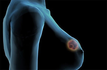 Аденома грудной железы: причины патологии, клиническая картина, ранние признаки, лечение