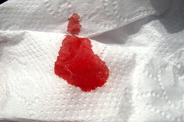 Кровотечение после прижигания эрозии шейки матки: лечение