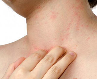 Признаки аллергии у взрослых - основные проявления, провоцирующие факторы, осложнения, методы лечения