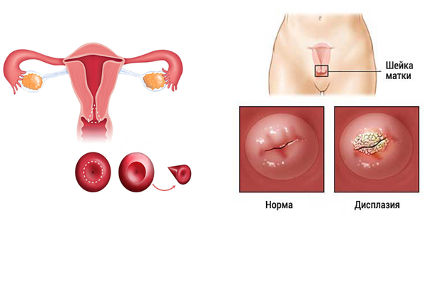 Беременность после конизации шейки матки: суть процедуры, когда применяют, возможные последствия