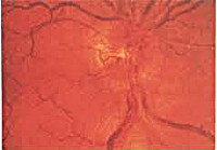 Неврит глазного нерва, его классификация и помощь народной медицины