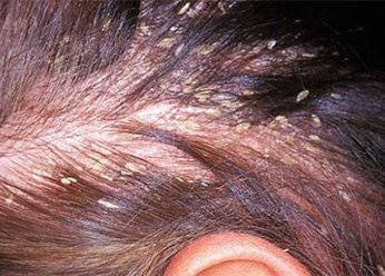 Себорея волосистой части головы: лечение, диагностирование, симптоматика и профилактика