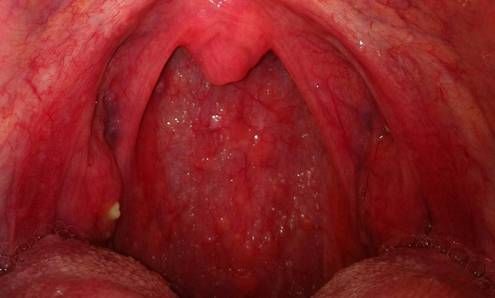 Чем отличается фарингит от ларингита: симптомы болезней горла и голосовых связок, терапия, осложнения