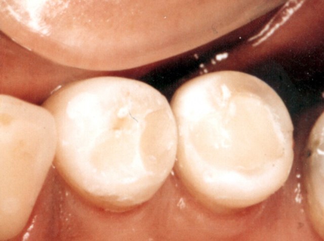 Какие бывают пломбы для зубов: цементные, металлические