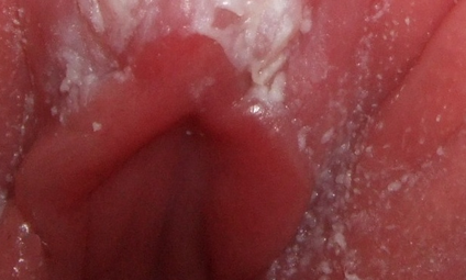 Язвы на половых губах – возможные причины и диагностика