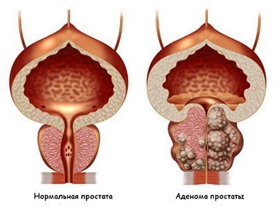 Аденома предстательной железы: операция по показаниям и развитие патологического процесса