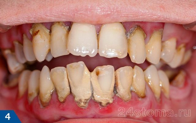 Камни на зубах: причины, методы распознавания, каким образом можно избавиться