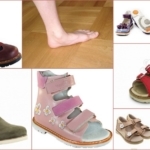 Какую обувь носить при плоскостопии при различных стадиях развития патологии