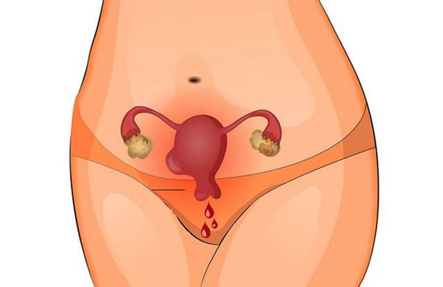 Через сколько после аборта приходят месячные - характер выделений, продолжительность менструаций